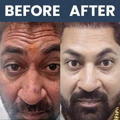 Botox Result