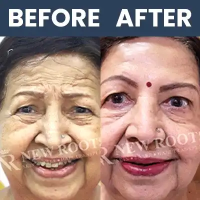 Botox Result